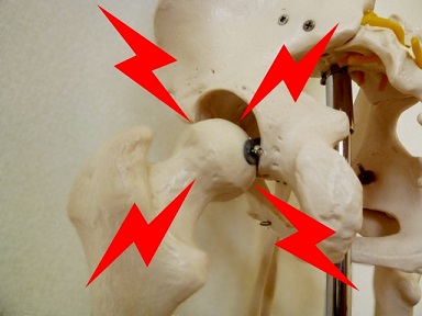 股関節の痛み　画像